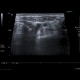 Acute enterocolitis, enteritis and colitis: US - Ultrasound